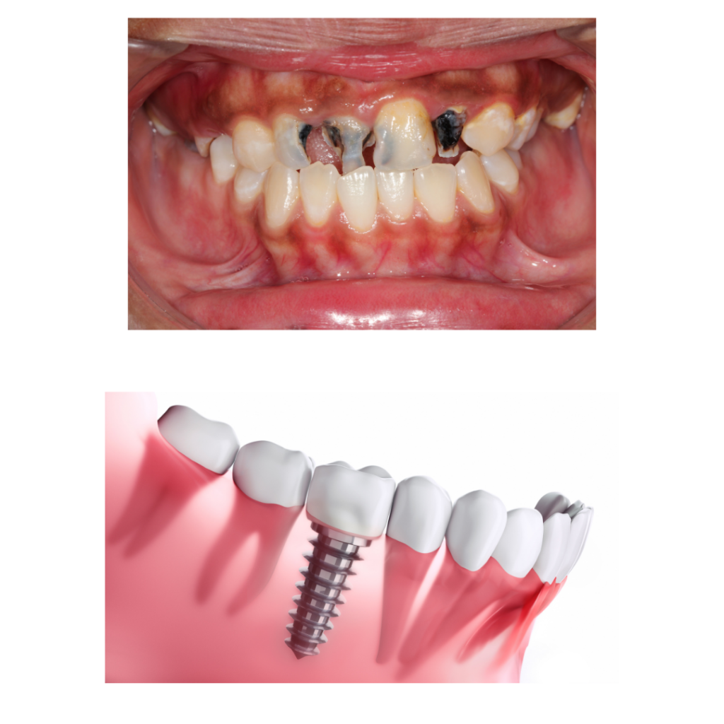 dental crown sharjah